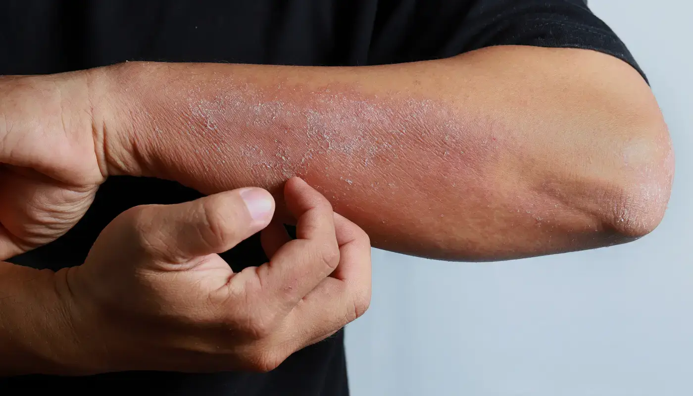 Eczéma : les aliments à éviter (et ceux à privilégier) pour calmer les crises