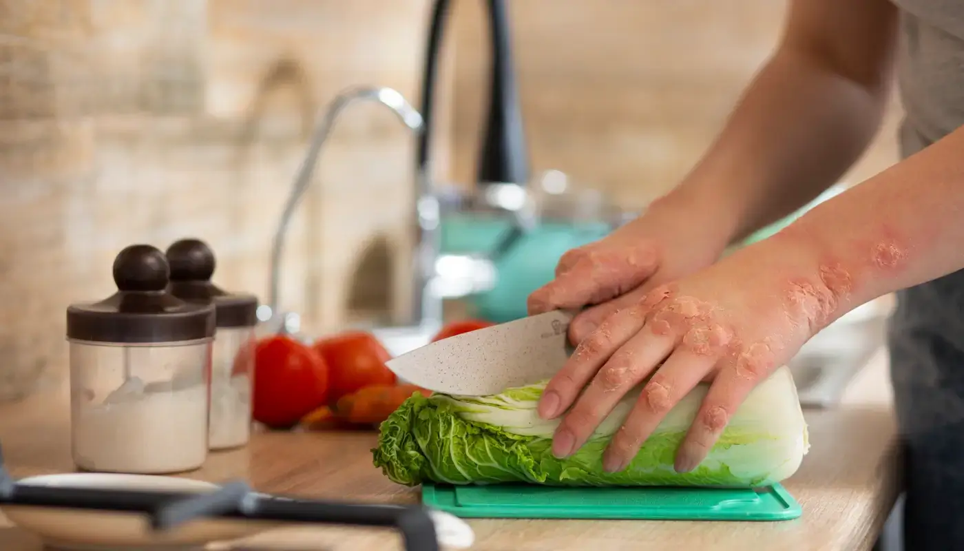 Psoriasis : quels aliments éviter pour apaiser ta peau ?